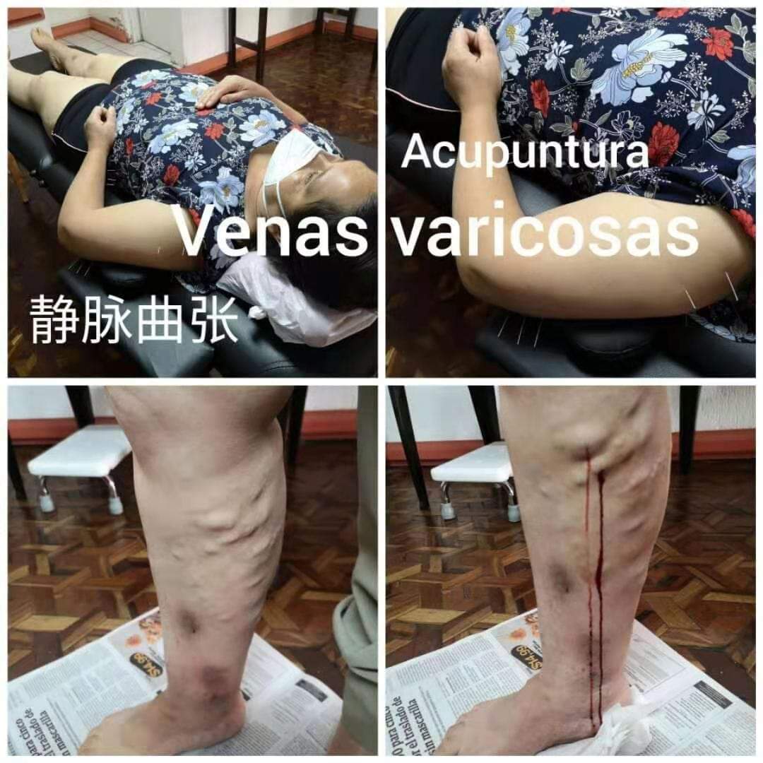 静脉曲张5.jpg